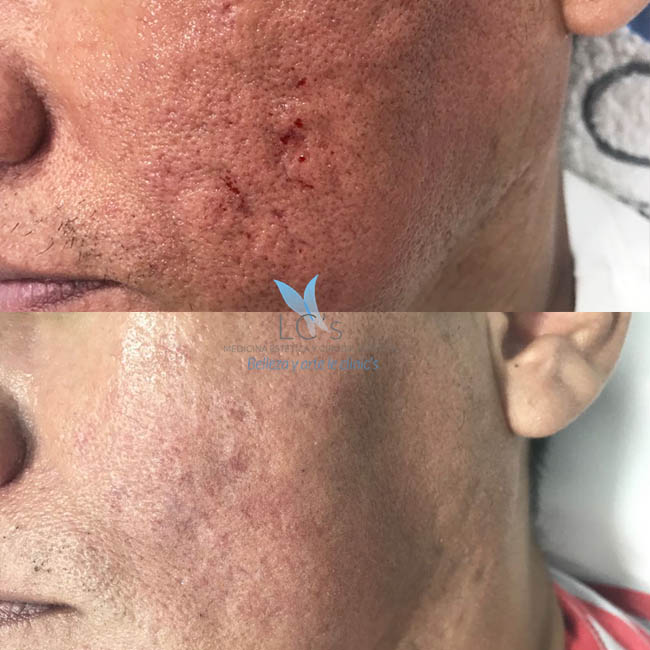 Marcas y cicatrices causadas por el acné.